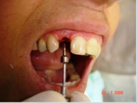 /album/galeria-de-fotos-carga-imediata-apos-exodontia-atraumatica-/carga-imediata-com-exodontia-atraumatica19-jpg/